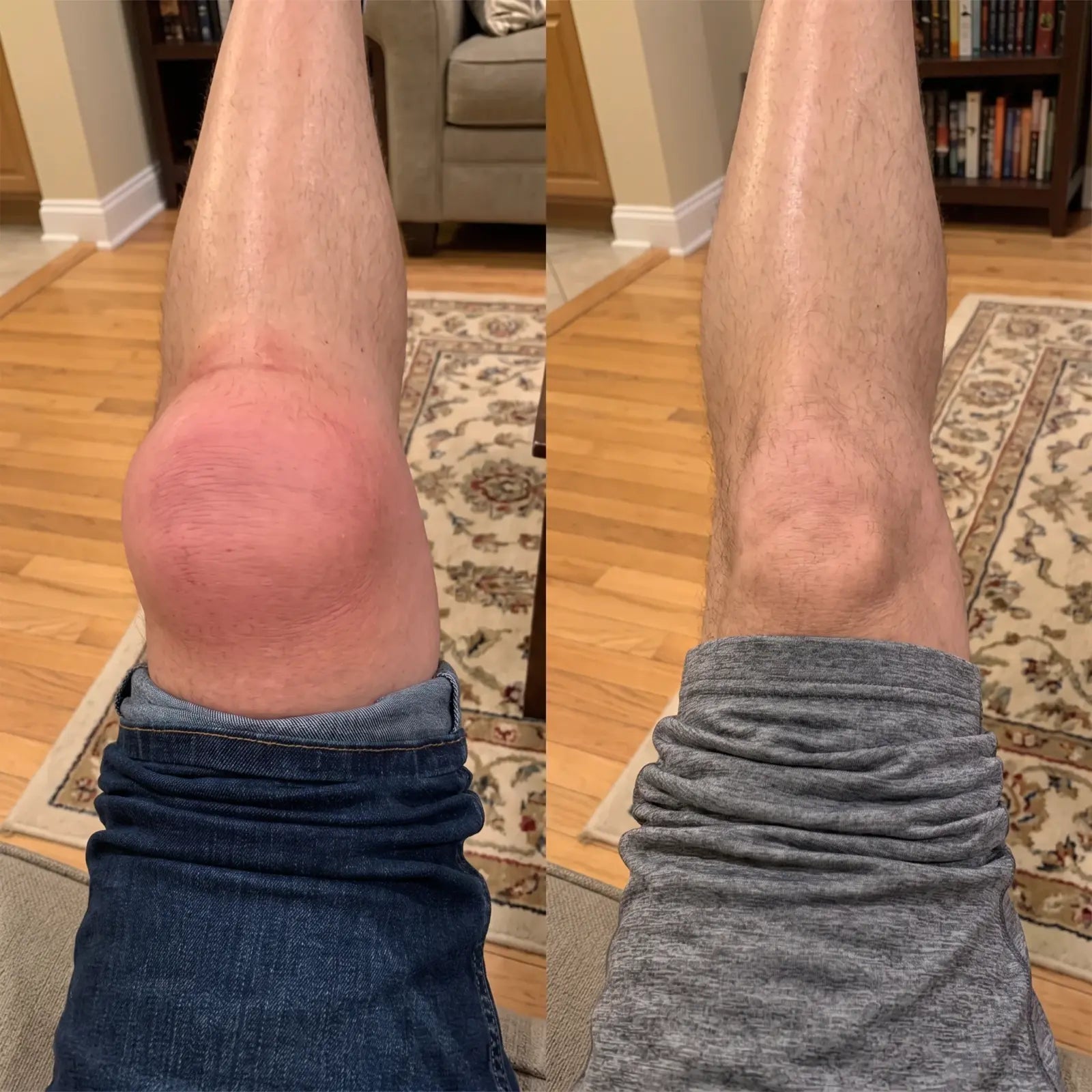 Swollen knee before and after comparison