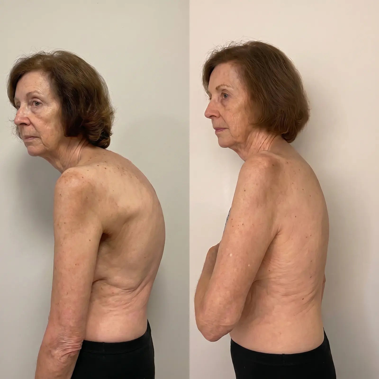 Back posture before and after comparison